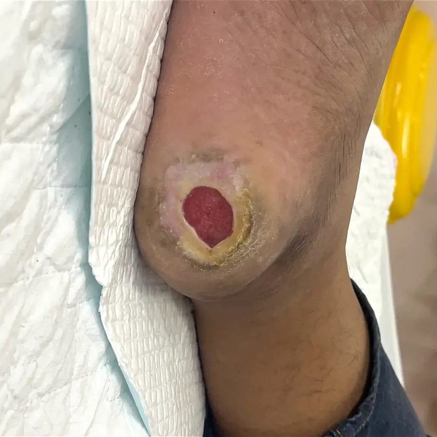 Clinical photograph of a diabetic heel wound at visit 3, HKL-21