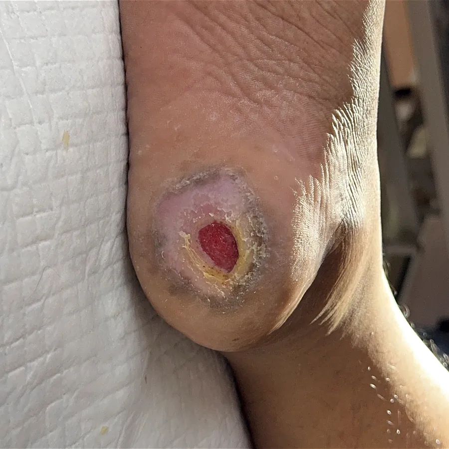 Clinical photograph of a diabetic heel wound at visit 4, HKL-21