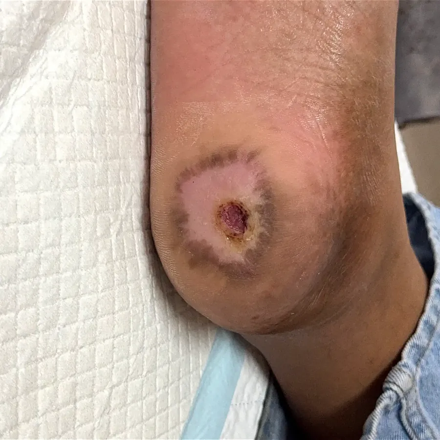 Clinical photograph of a diabetic heel wound at visit 5, HKL-21