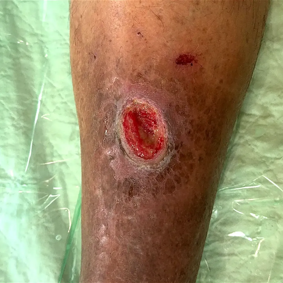 Clinical photograph of a trauma-related leg wound at visit 1, HKL-22