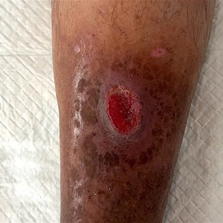 Clinical photograph of a trauma-related leg wound at visit 2, HKL-22