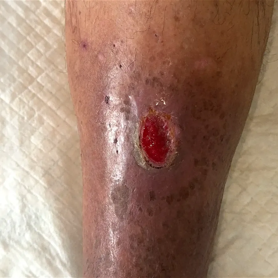 Clinical photograph of a trauma-related leg wound at visit 3, HKL-22