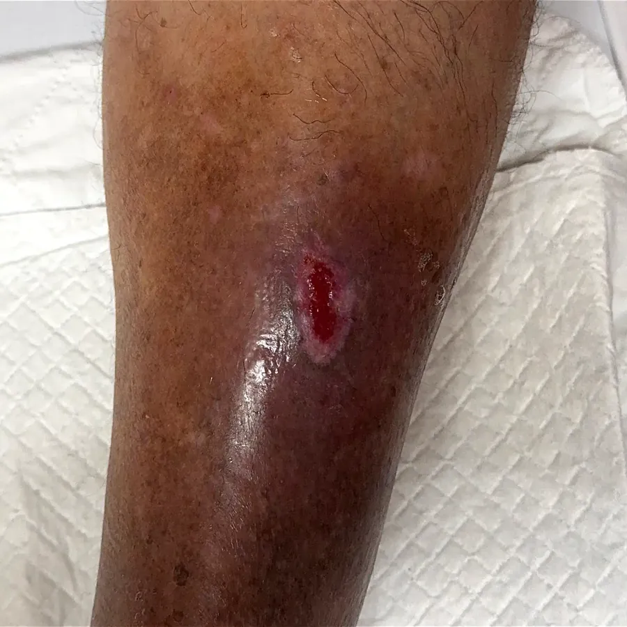 Clinical photograph of a trauma-related leg wound at visit 4, HKL-22