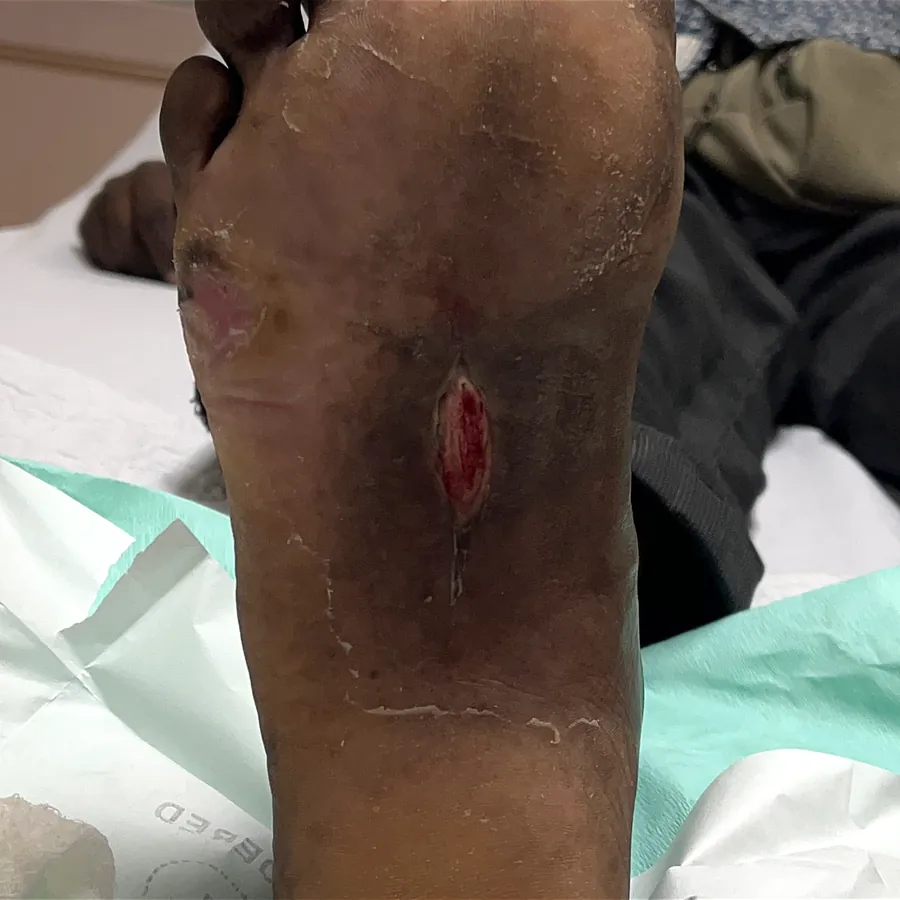 Clinical photograph of a diabetic plantar wound at visit 1, HKL-23