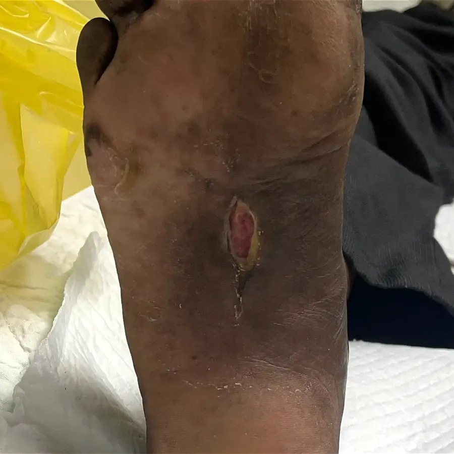 Clinical photograph of a diabetic plantar wound at visit 2, HKL-23