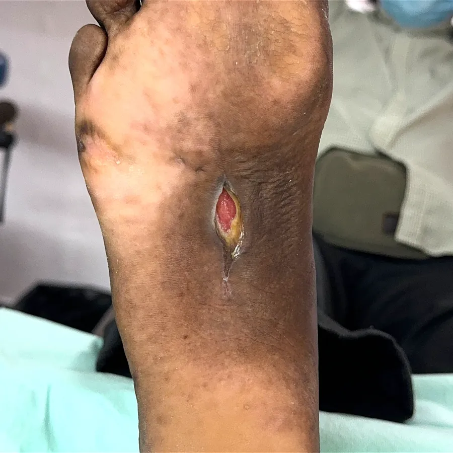 Clinical photograph of a diabetic plantar wound at visit 3, HKL-23