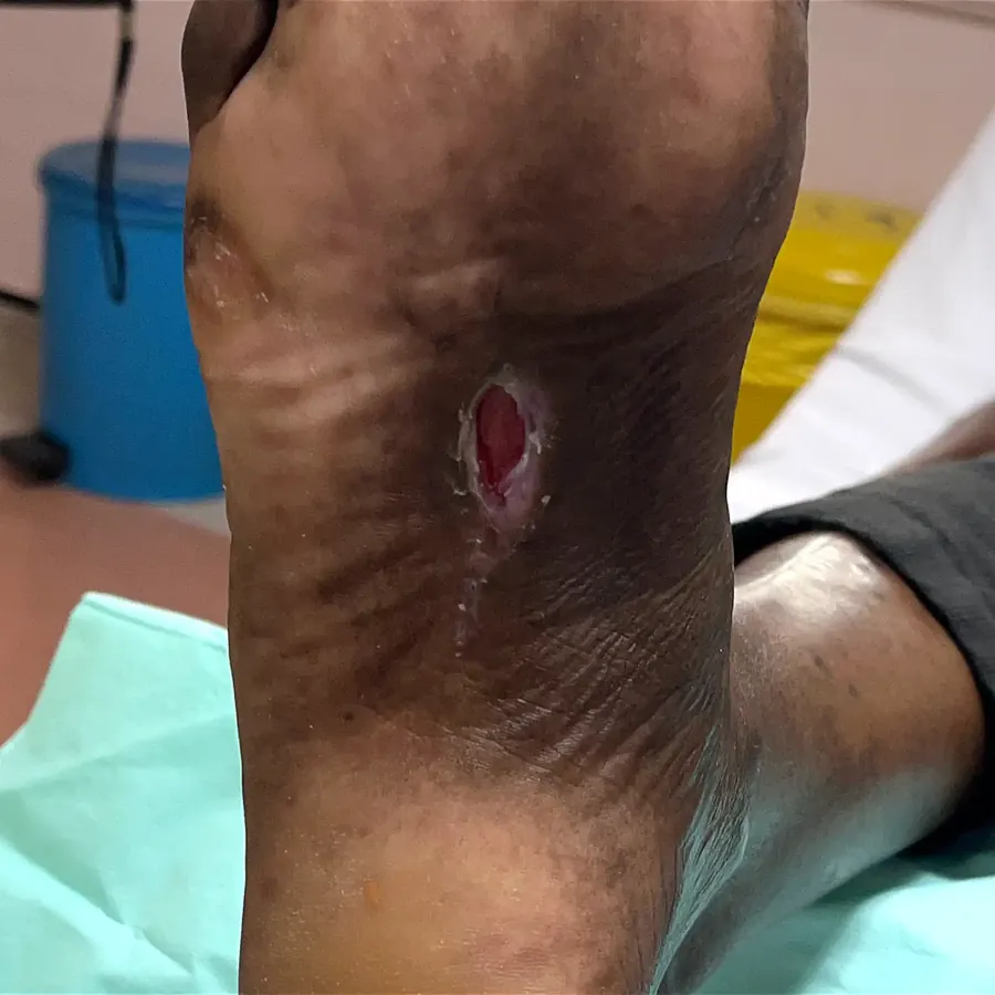 Clinical photograph of a diabetic plantar wound at visit 4, HKL-23