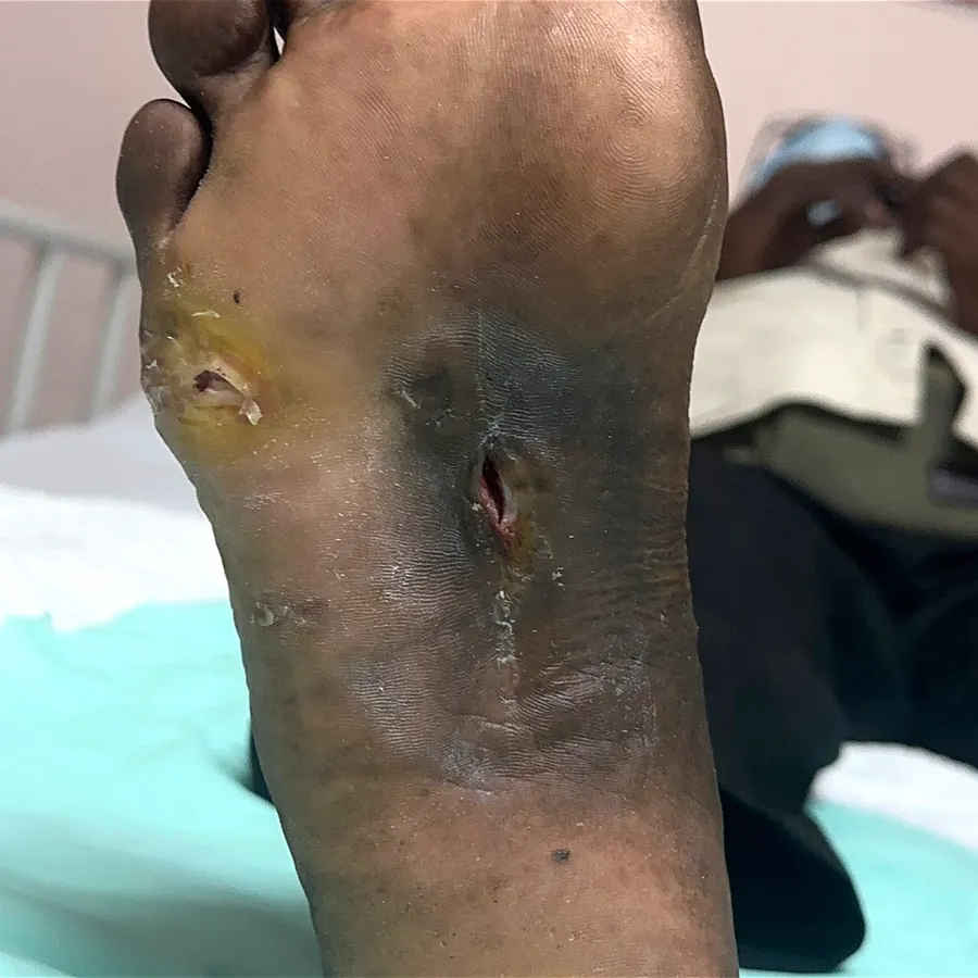 Clinical photograph of a diabetic plantar wound at visit 5, HKL-23