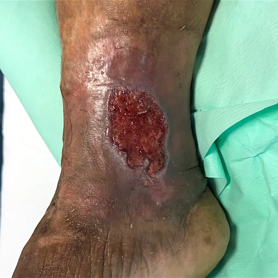 Clinical photograph of a lymphovascular leg wound at visit 1, HKL-24