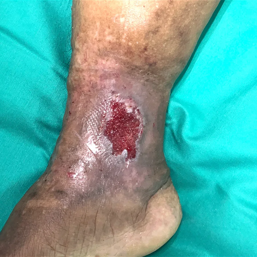 Clinical photograph of a lymphovascular leg wound at visit 2, HKL-24
