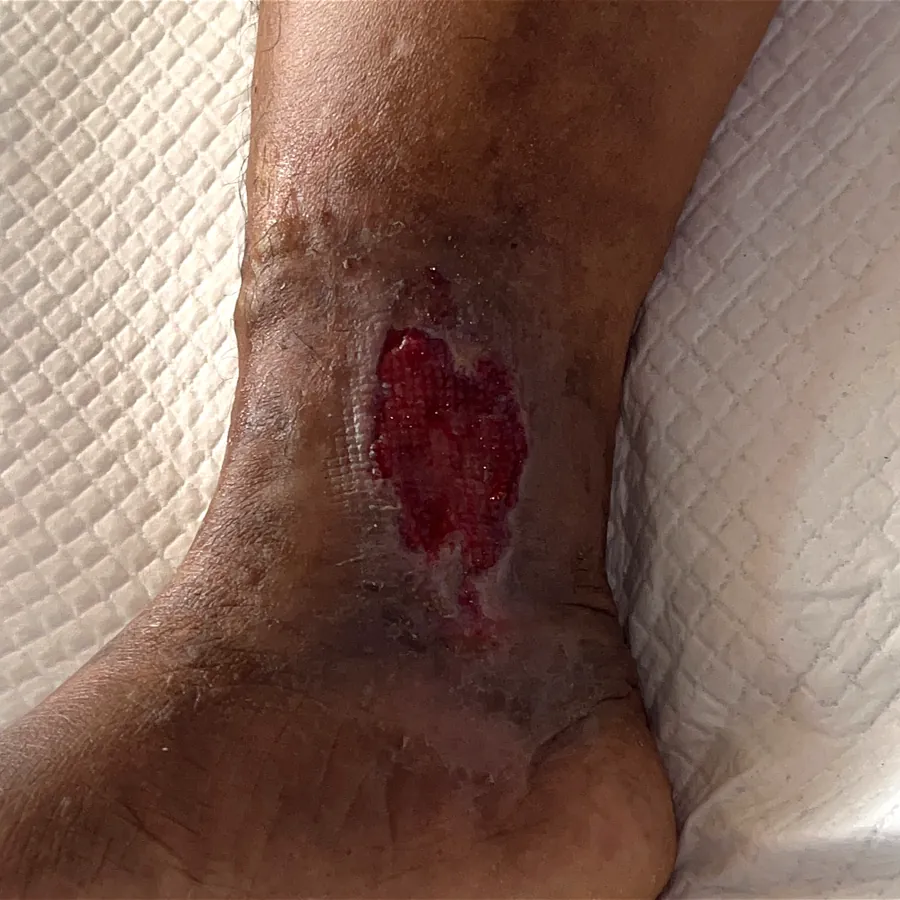 Clinical photograph of a lymphovascular leg wound at visit 3, HKL-24