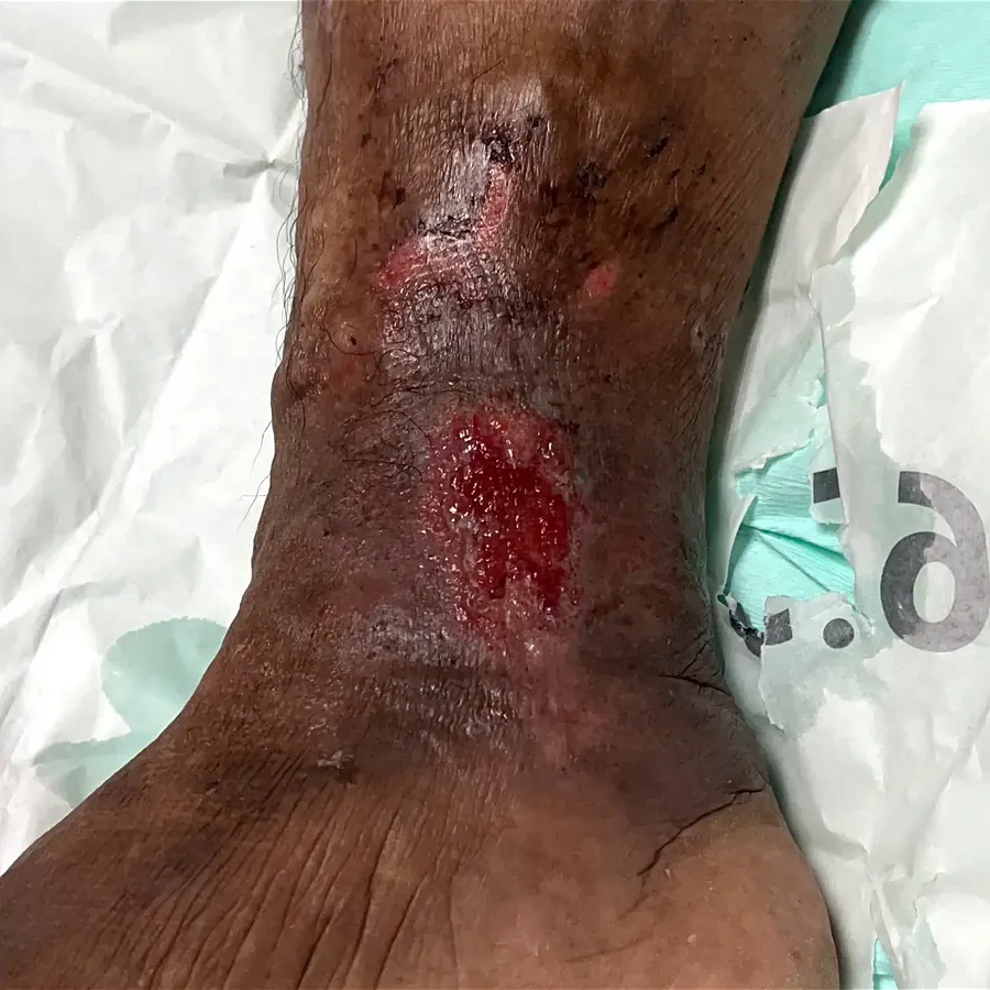 Clinical photograph of a lymphovascular leg wound at visit 4, HKL-24