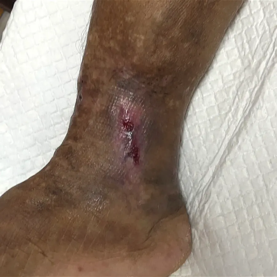 Clinical photograph of a lymphovascular leg wound at visit 5, HKL-24