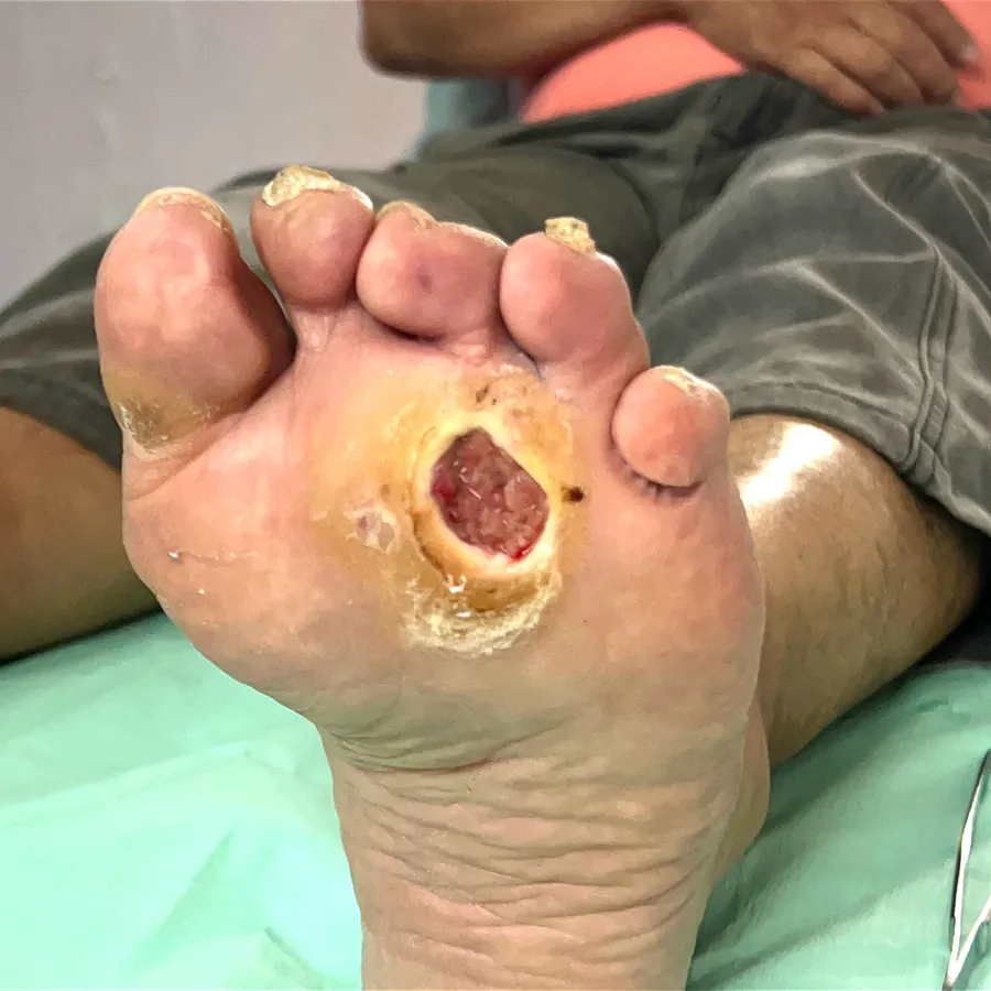 Clinical photograph of a diabetic plantar wound at visit 1, HKL-25