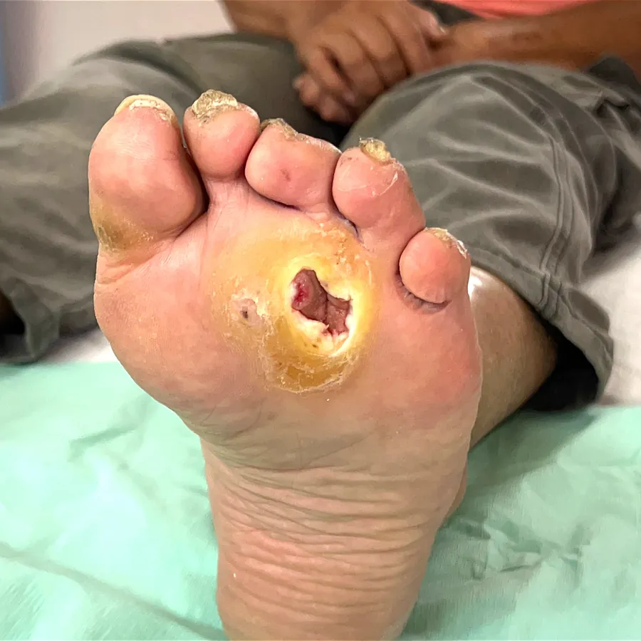 Clinical photograph of a diabetic plantar wound at visit 2, HKL-25