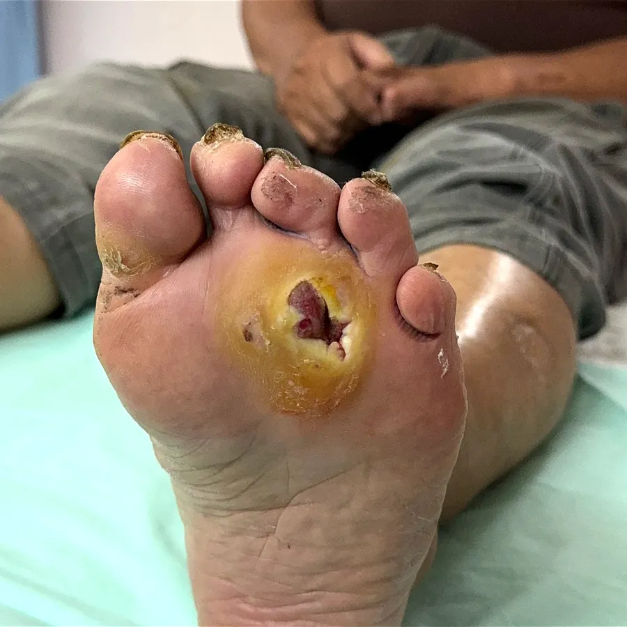 Clinical photograph of a diabetic plantar wound at visit 3, HKL-25