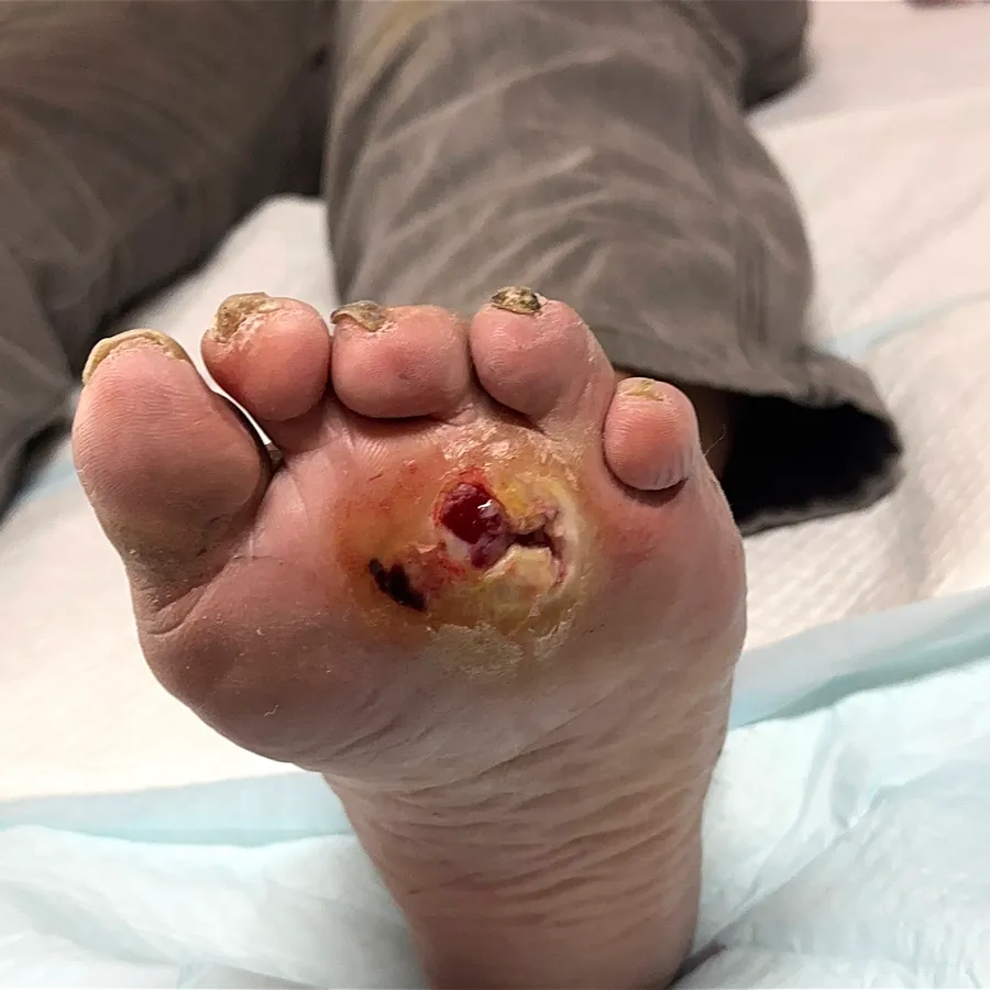 Clinical photograph of a diabetic plantar wound at visit 4, HKL-25