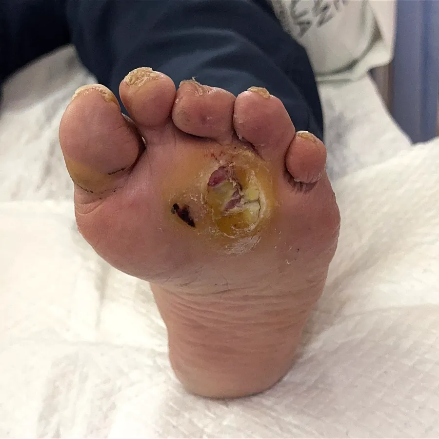 Clinical photograph of a diabetic plantar wound at visit 5, HKL-25