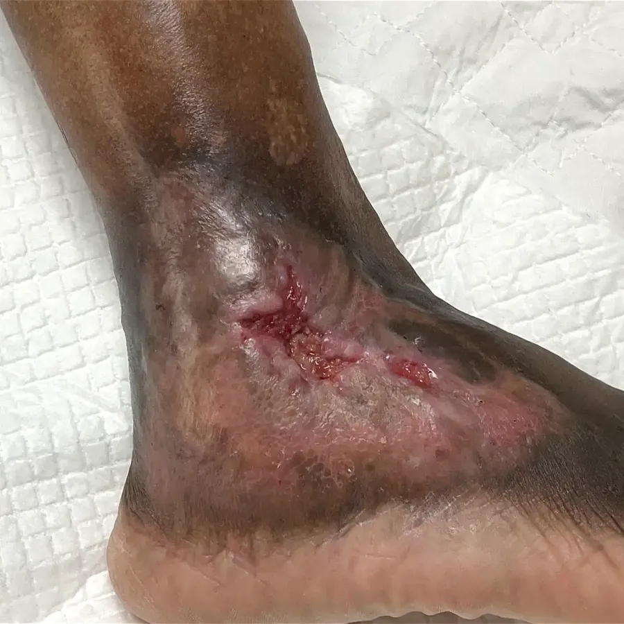 Clinical photograph of a lymphovascular foot wound at visit 1, HKL-26