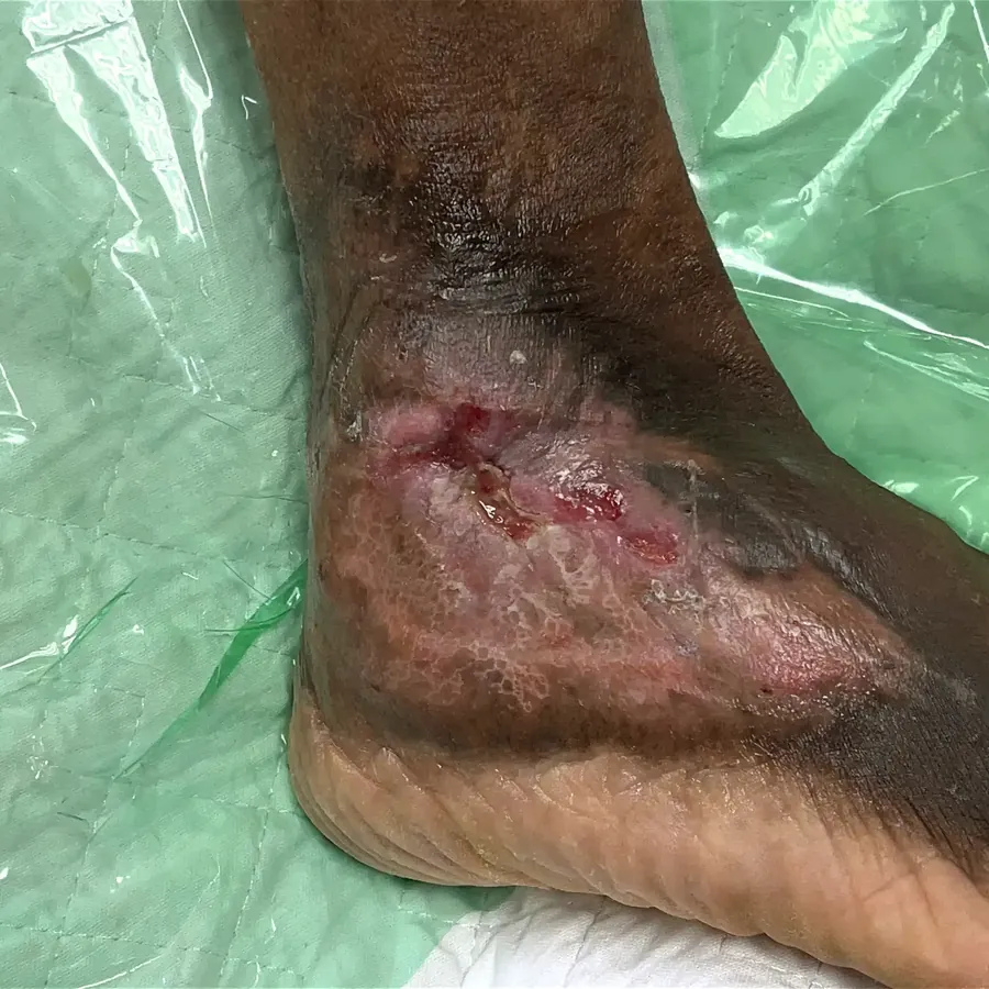 Clinical photograph of a lymphovascular foot wound at visit 2, HKL-26