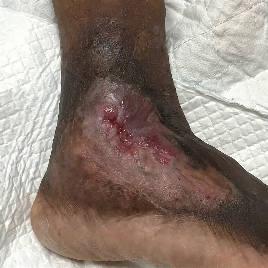 Clinical photograph of a lymphovascular foot wound at visit 3, HKL-26