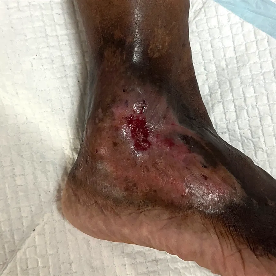 Clinical photograph of a lymphovascular foot wound at visit 4, HKL-26