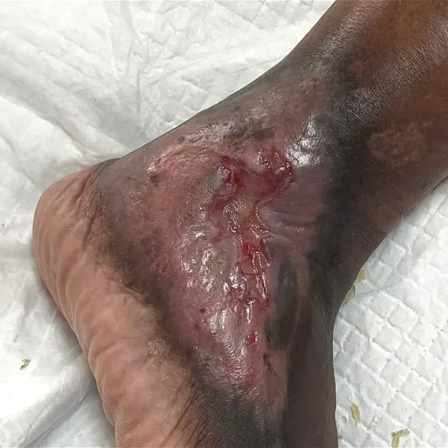 Clinical photograph of a lymphovascular foot wound at visit 5, HKL-26