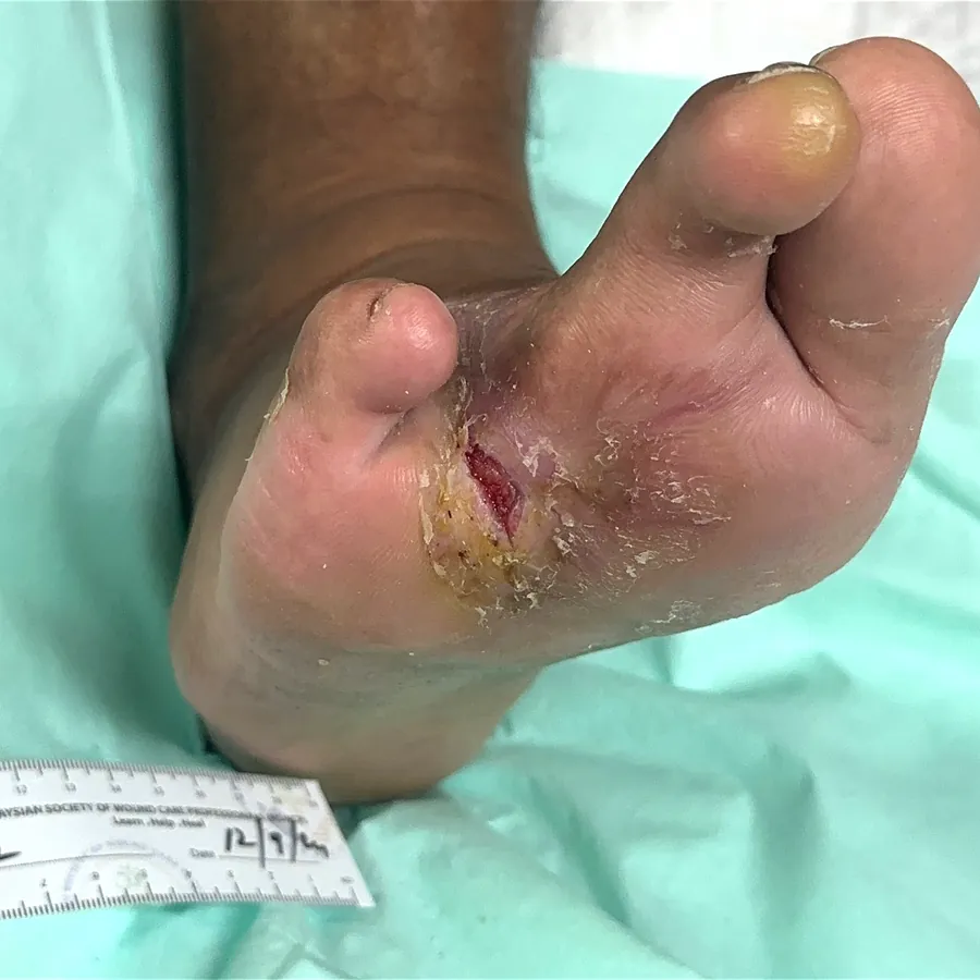 Clinical photograph of a diabetic plantar wound at visit 1, HKL-27