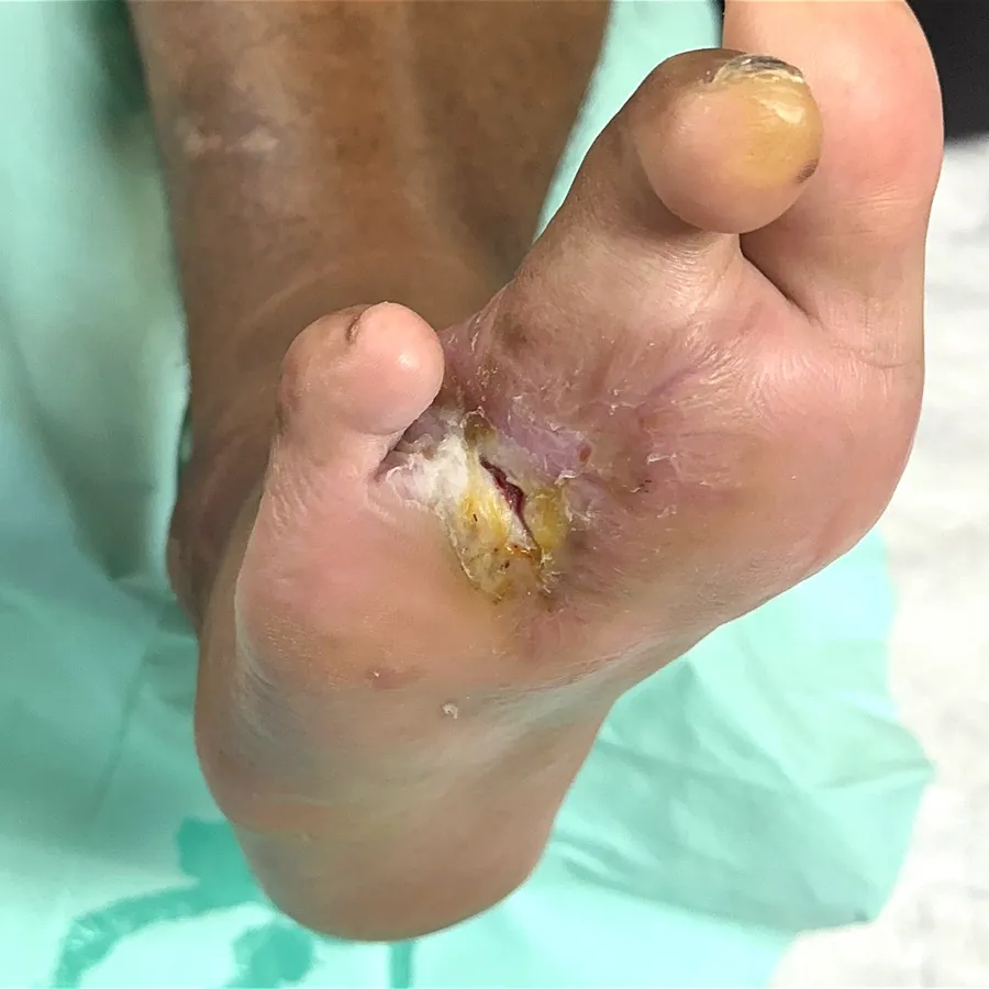 Clinical photograph of a diabetic plantar wound at visit 2, HKL-27