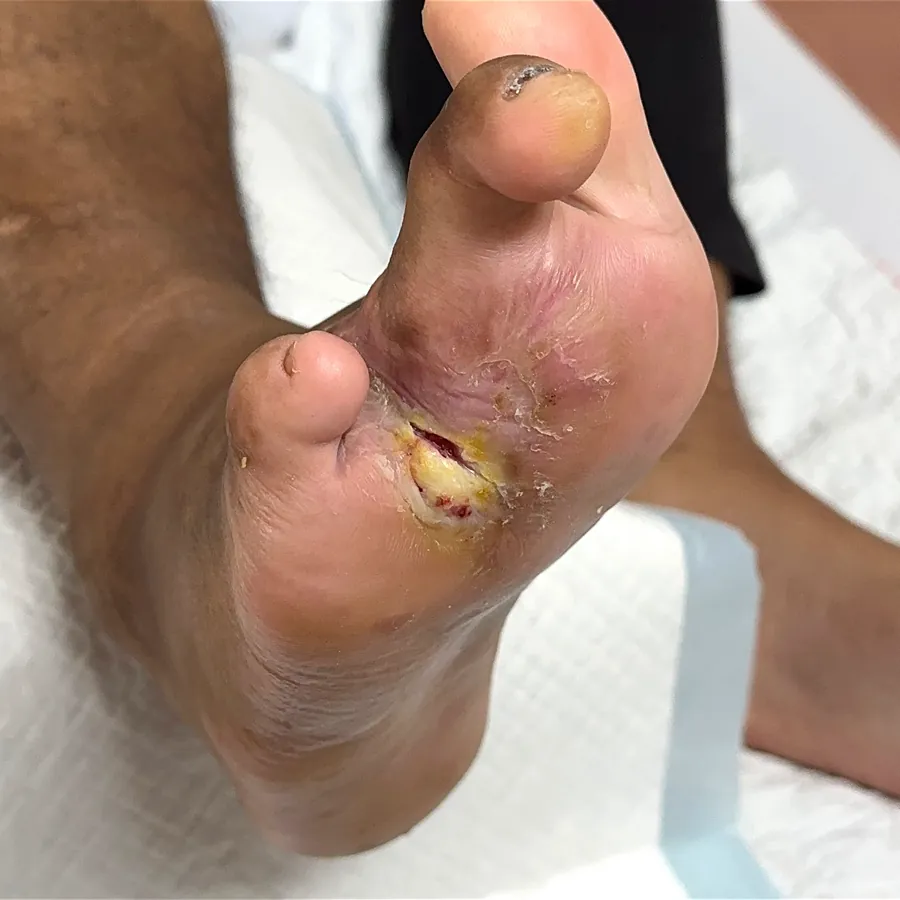 Clinical photograph of a diabetic plantar wound at visit 3, HKL-27