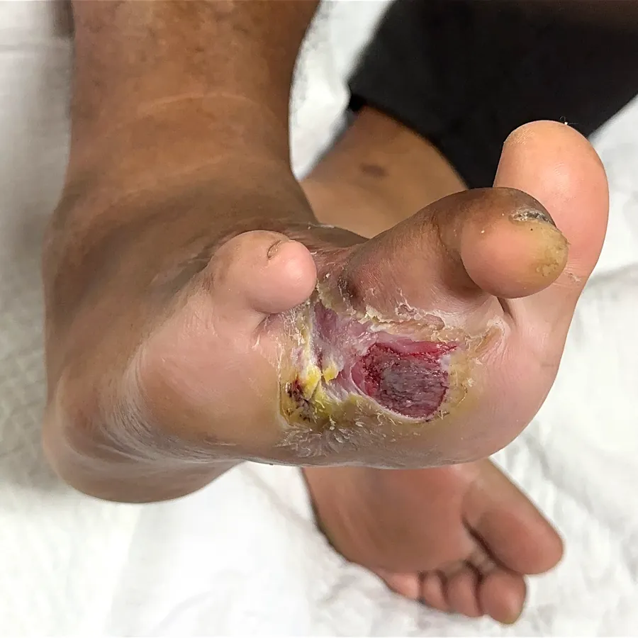 Clinical photograph of a diabetic plantar wound at visit 4, HKL-27