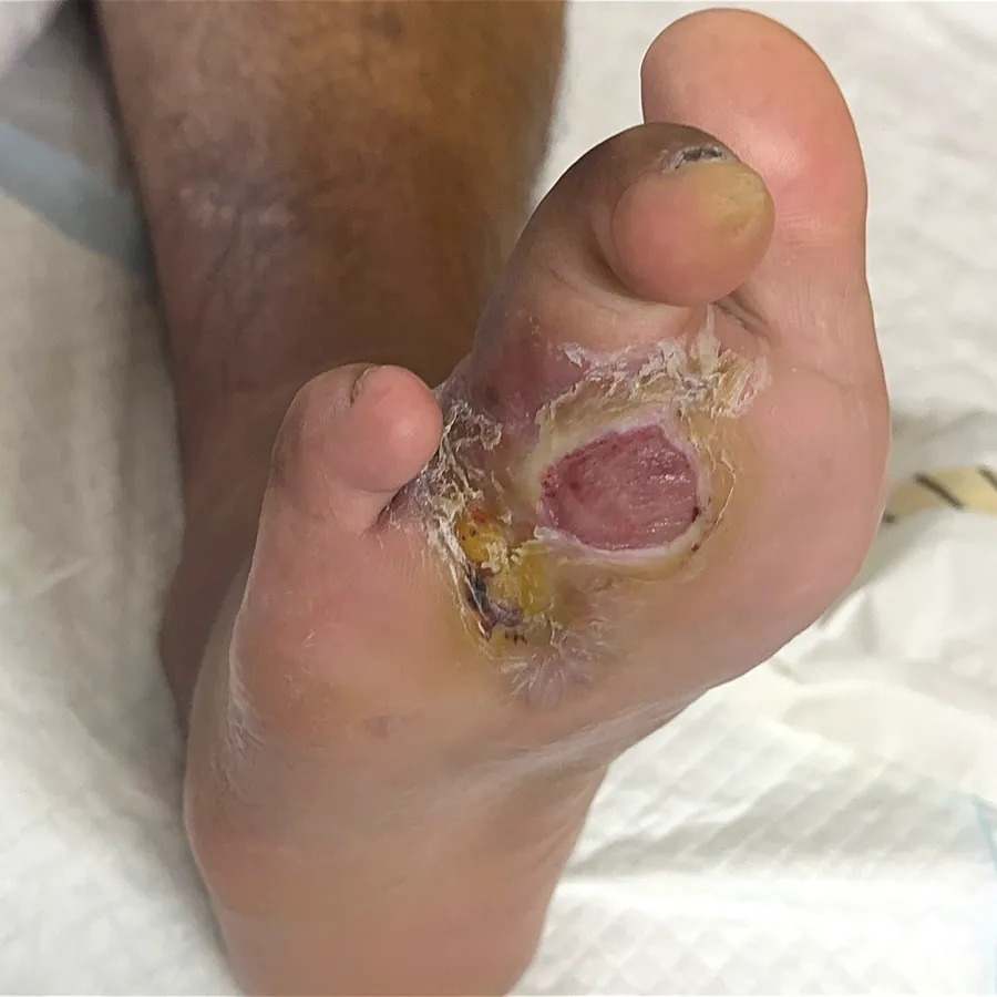 Clinical photograph of a diabetic plantar wound at visit 5, HKL-27