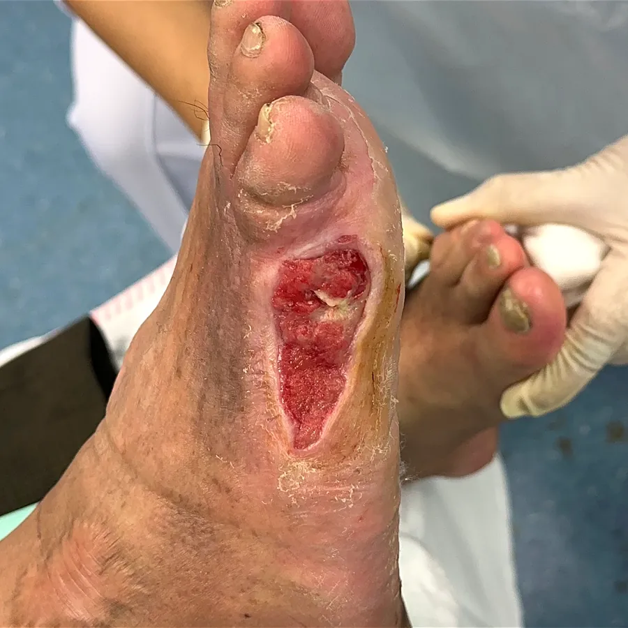 Clinical photograph of a diabetic plantar wound at visit 1, HKL-28
