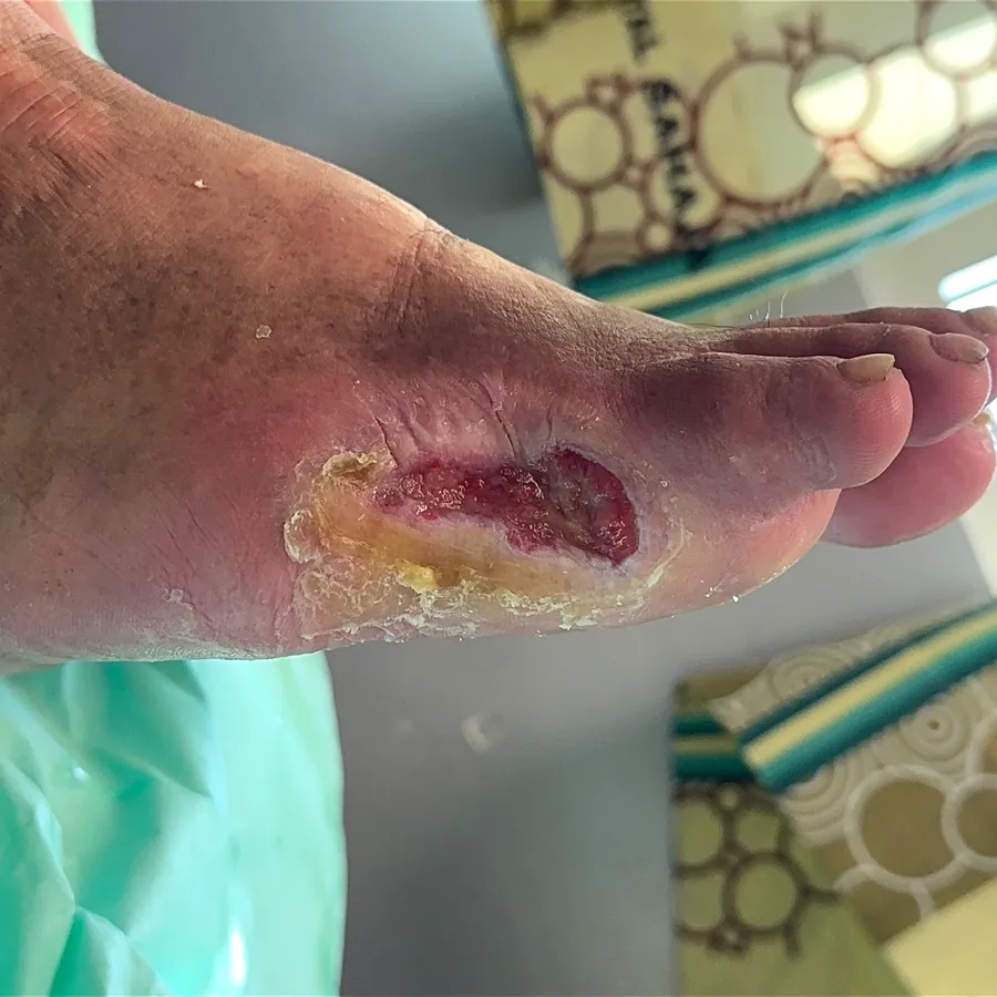 Clinical photograph of a diabetic plantar wound at visit 2, HKL-28