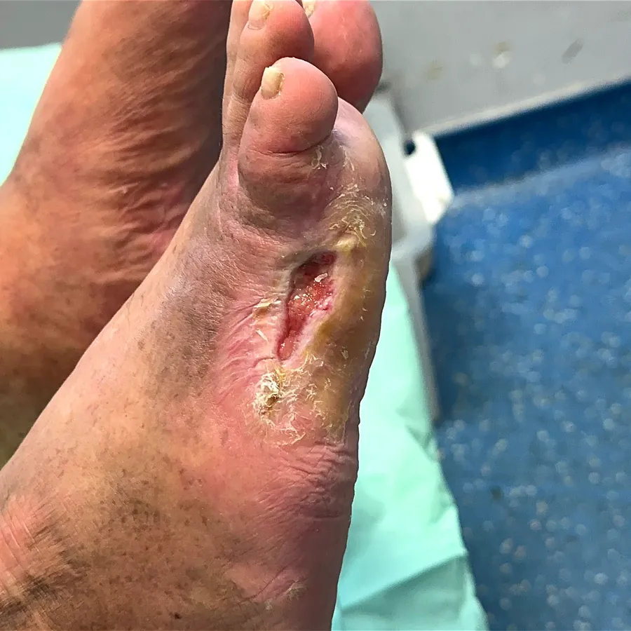 Clinical photograph of a diabetic plantar wound at visit 3, HKL-28