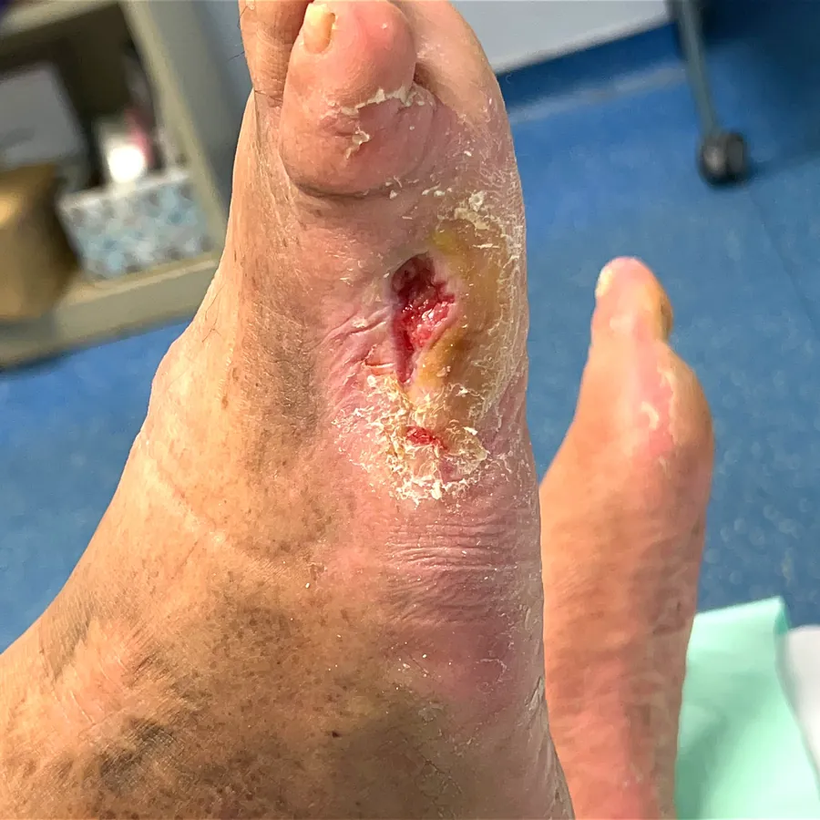 Clinical photograph of a diabetic plantar wound at visit 4, HKL-28