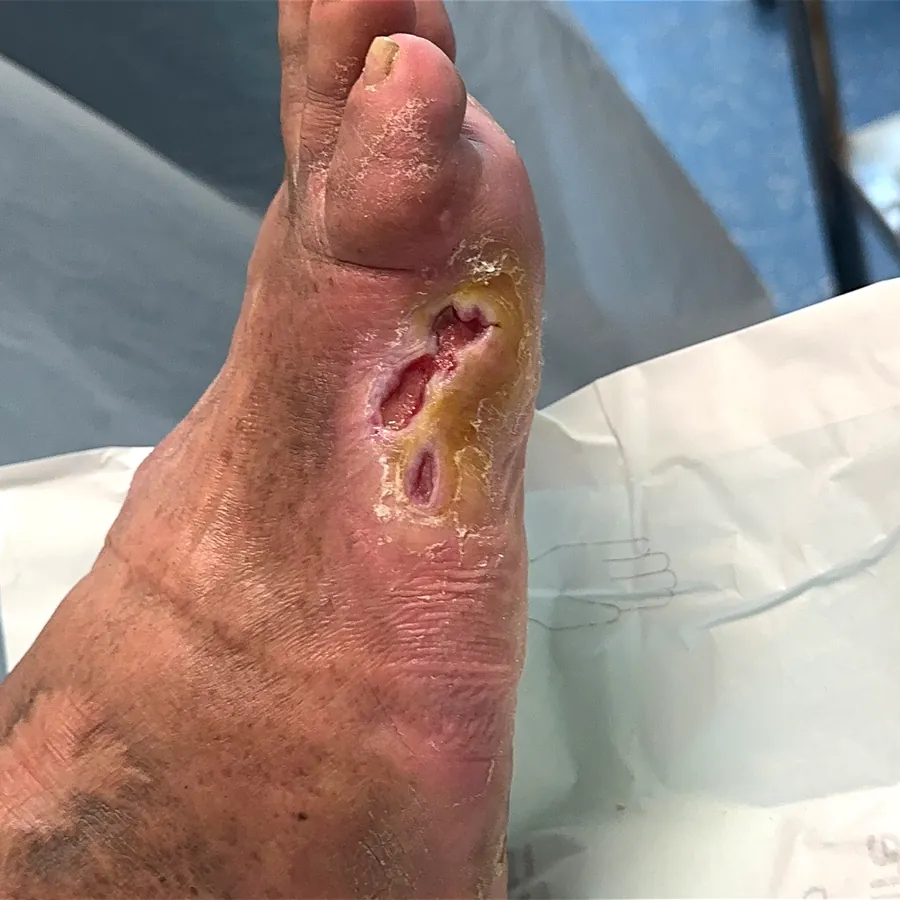 Clinical photograph of a diabetic plantar wound at visit 5, HKL-28