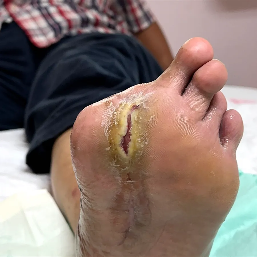 Clinical photograph of a diabetic plantar wound at visit 1, HKL-29