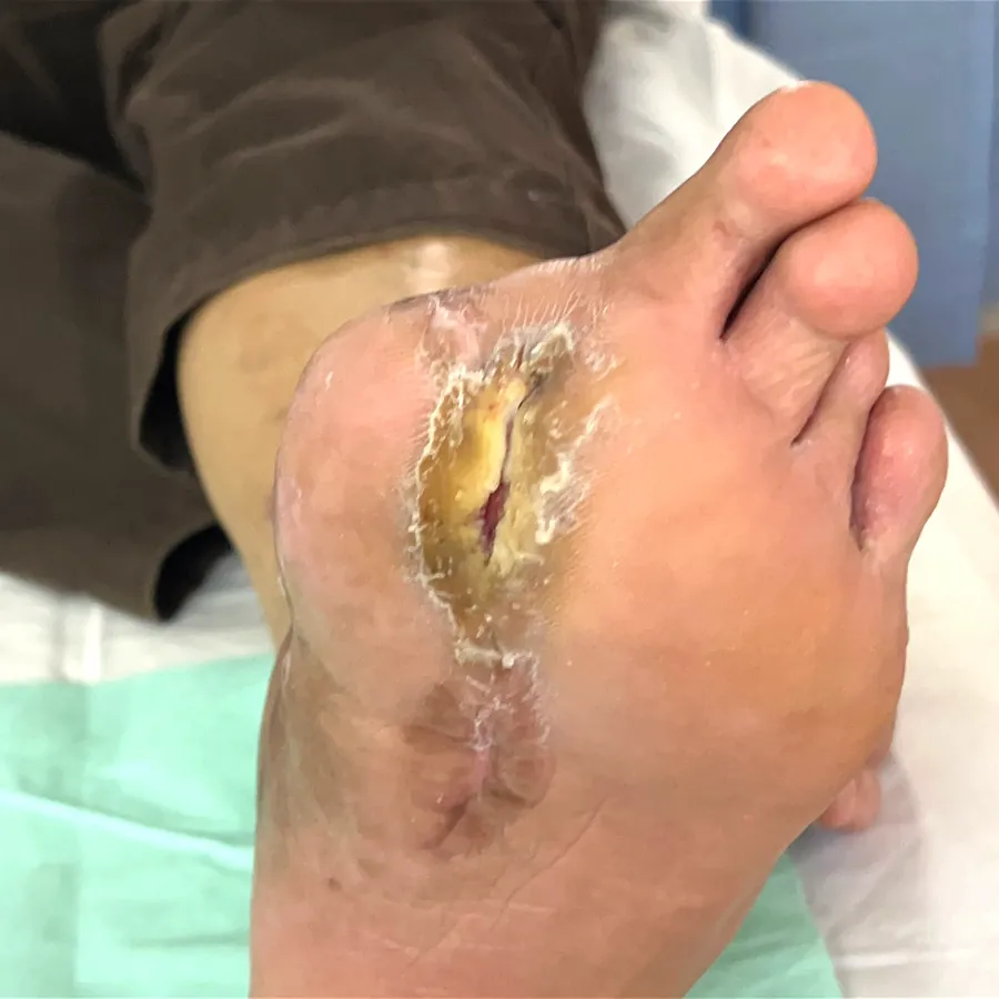Clinical photograph of a diabetic plantar wound at visit 2, HKL-29