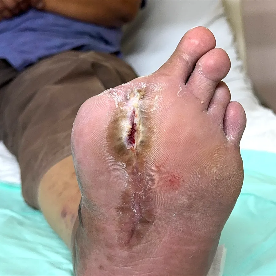 Clinical photograph of a diabetic plantar wound at visit 3, HKL-29