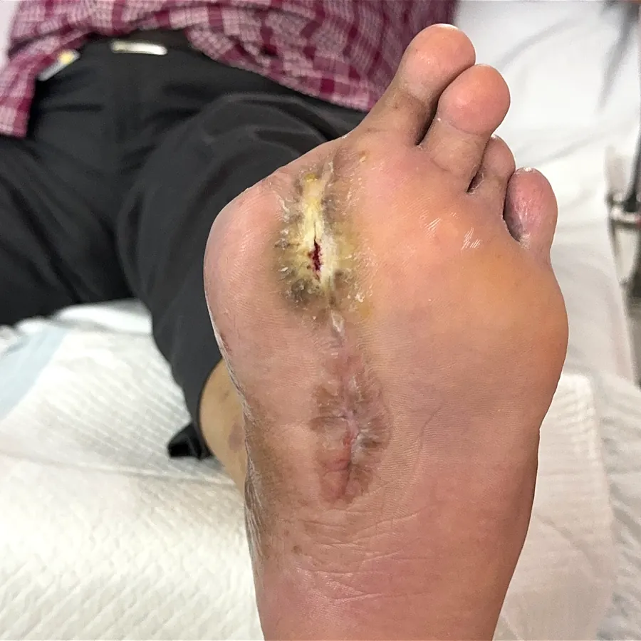 Clinical photograph of a diabetic plantar wound at visit 4, HKL-29