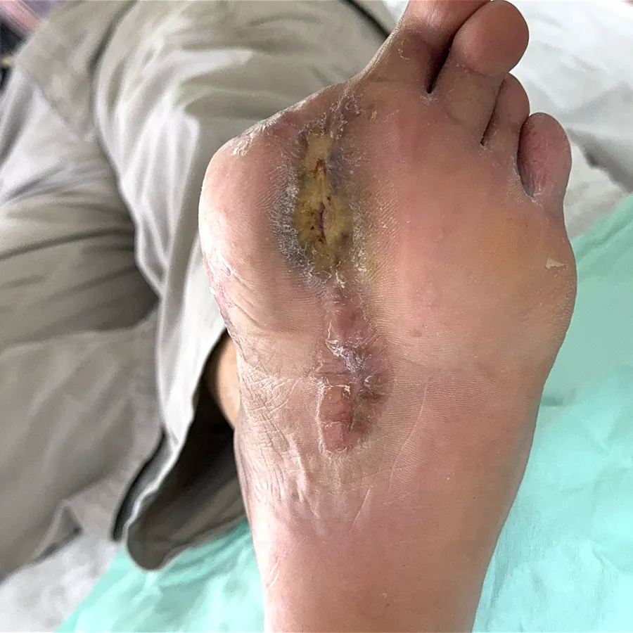 Clinical photograph of a diabetic plantar wound at visit 5, HKL-29