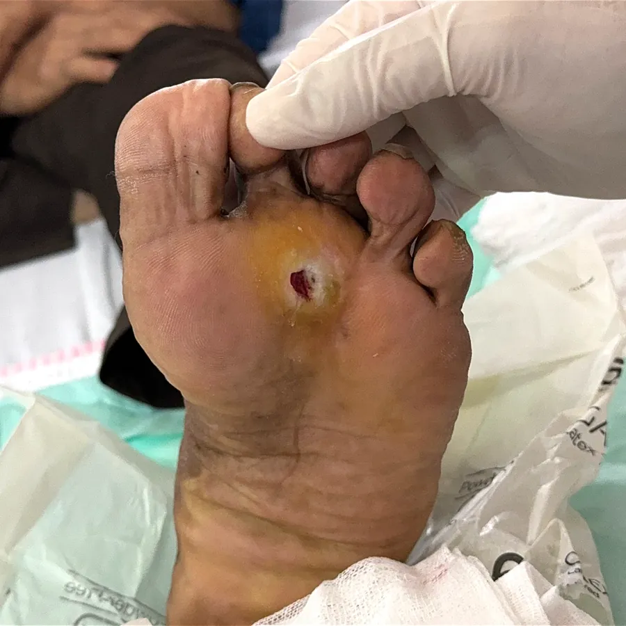 Clinical photograph of a diabetic plantar wound at visit 1, HKL-30