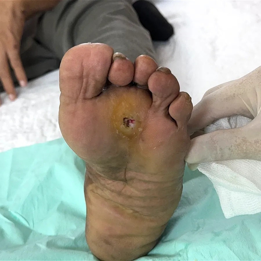 Clinical photograph of a diabetic plantar wound at visit 2, HKL-30