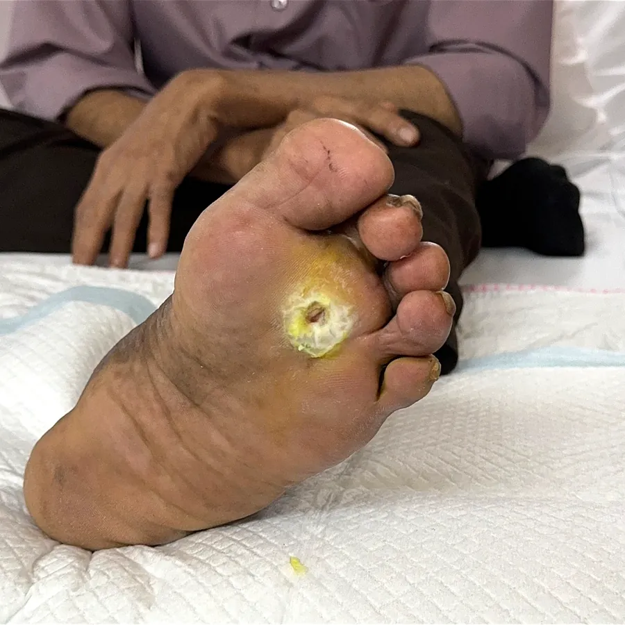 Clinical photograph of a diabetic plantar wound at visit 3, HKL-30
