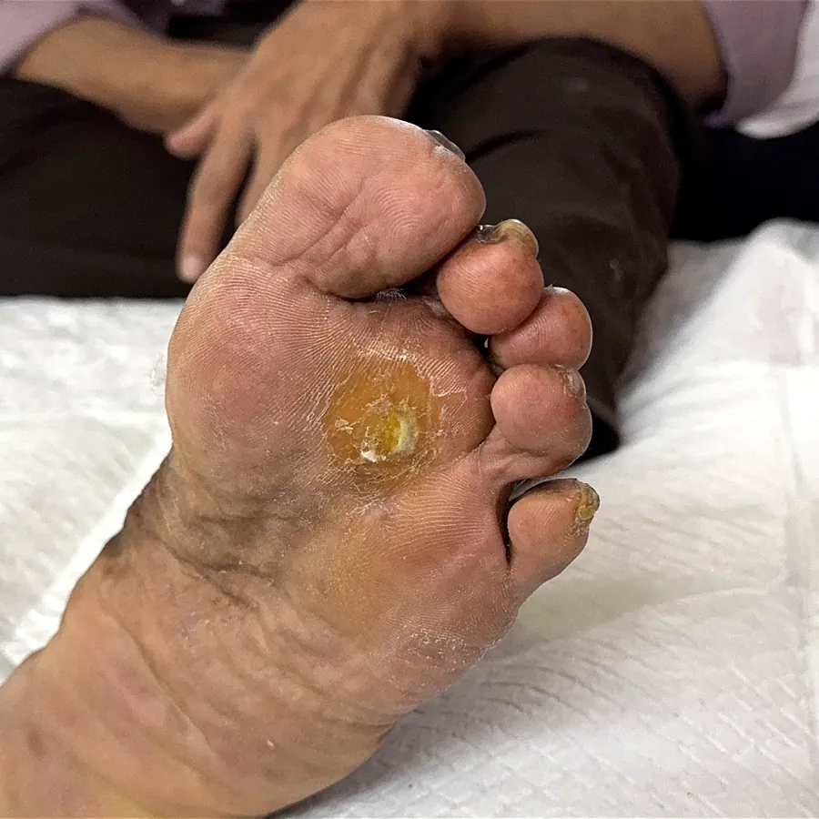 Clinical photograph of a diabetic plantar wound at visit 4, HKL-30
