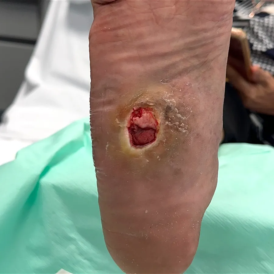 Clinical photograph of a diabetic plantar wound at visit 1, HKL-31