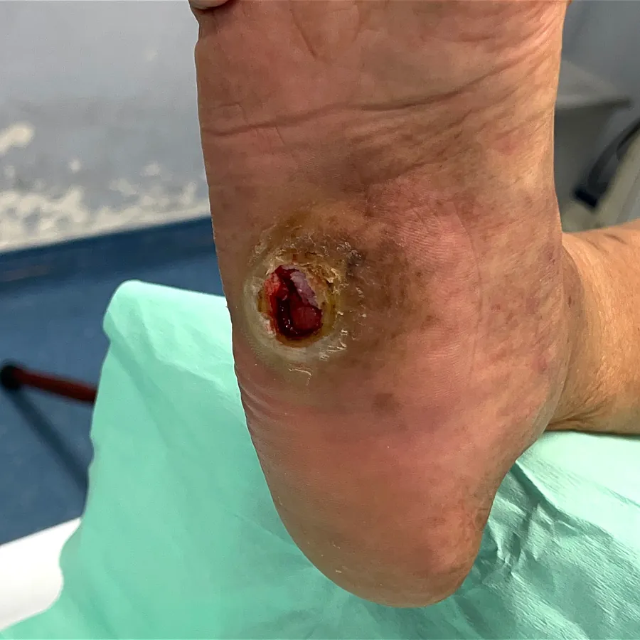 Clinical photograph of a diabetic plantar wound at visit 2, HKL-31
