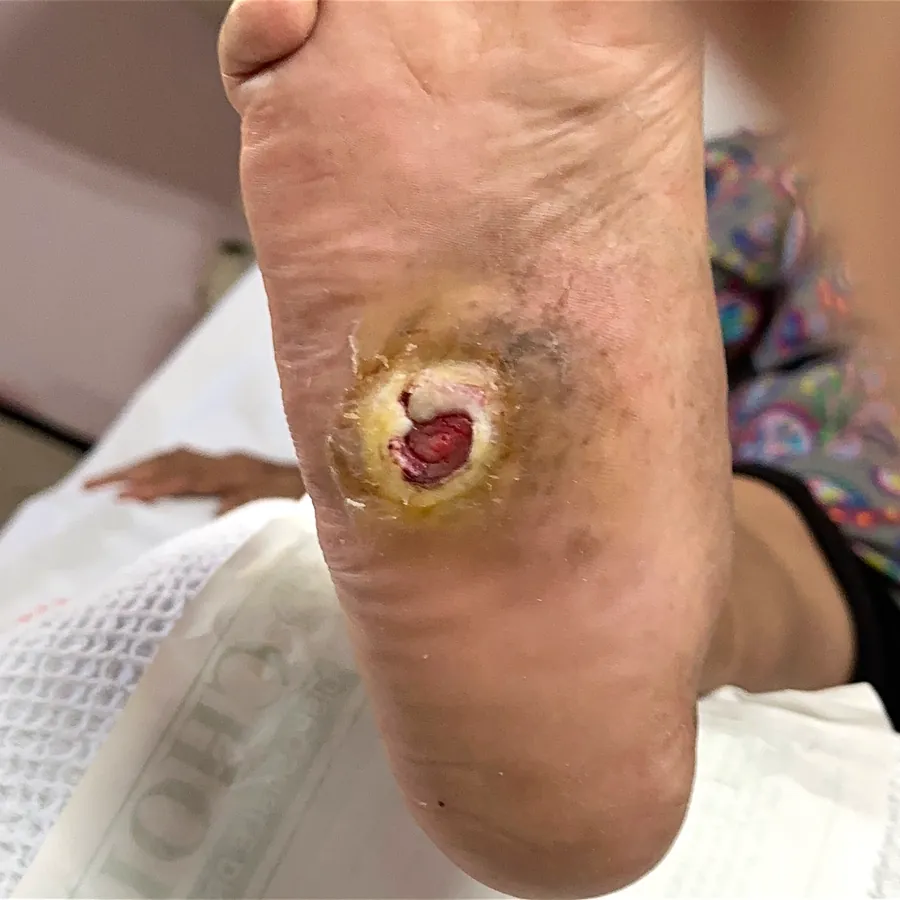 Clinical photograph of a diabetic plantar wound at visit 3, HKL-31