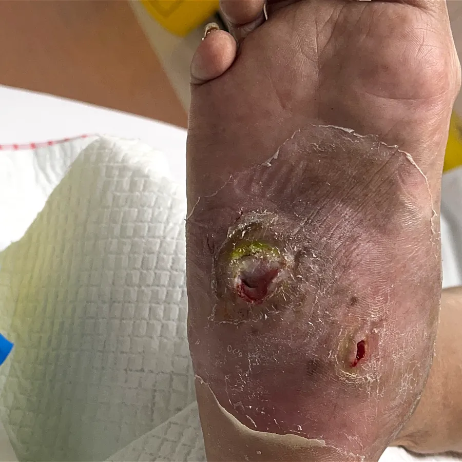 Clinical photograph of a diabetic plantar wound at visit 4, HKL-31